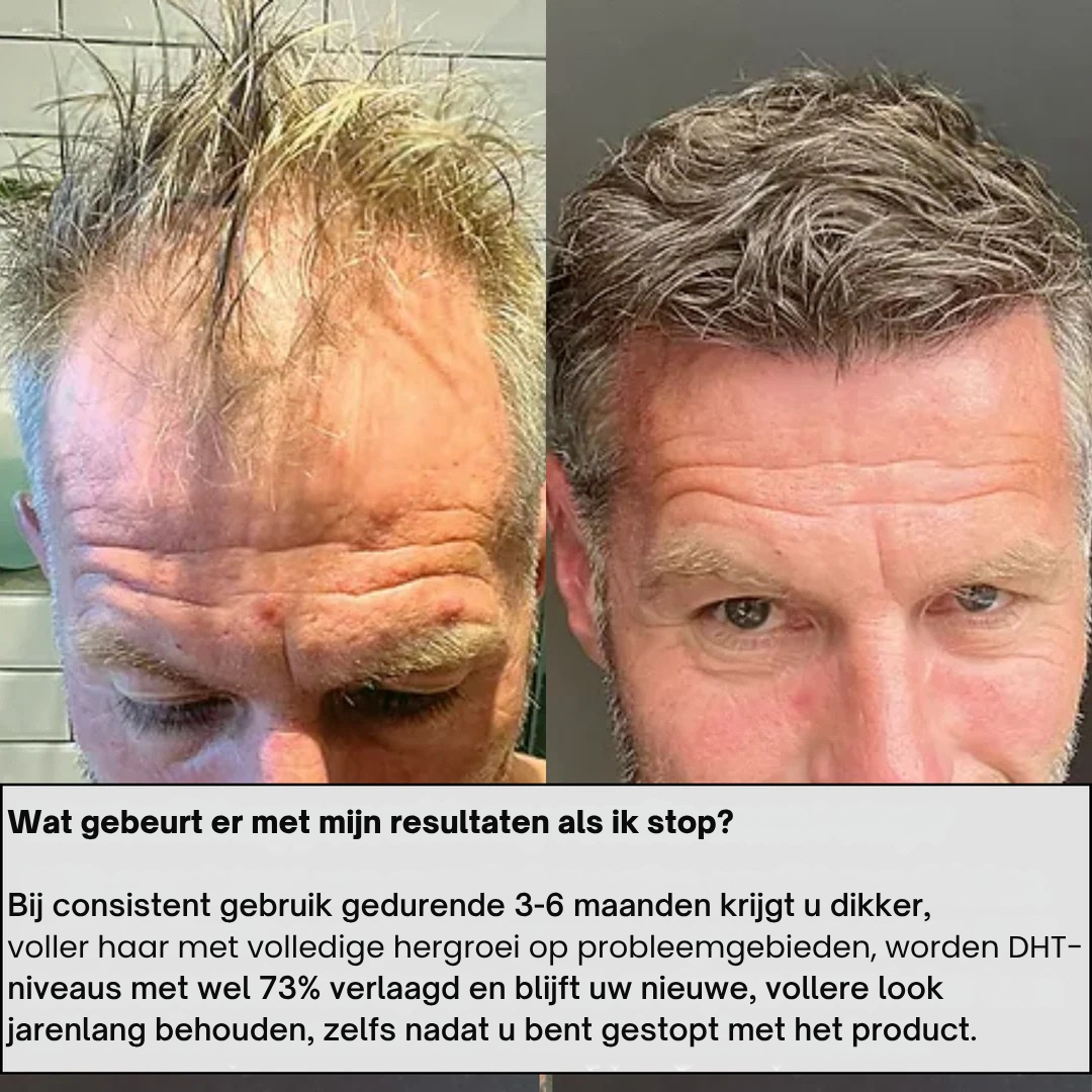 AlphaInfuse™ Haargroei Systeem
