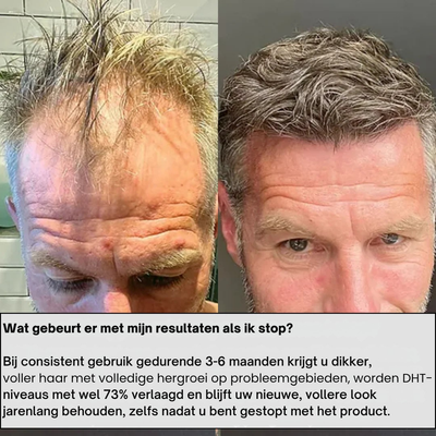 AlphaInfuse™ Haargroei Systeem