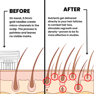 AlphaInfuse™ Haargroei Systeem