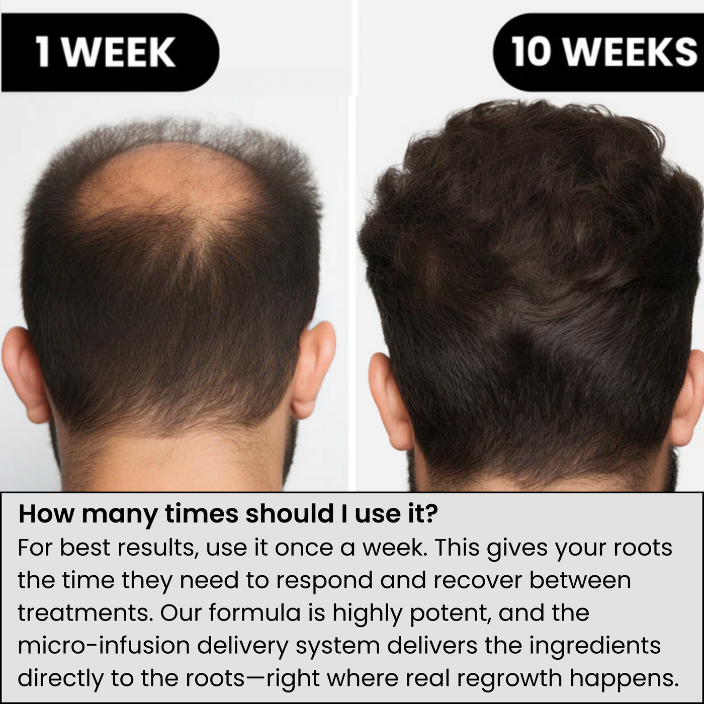 AlphaInfuse™ Haargroei Systeem